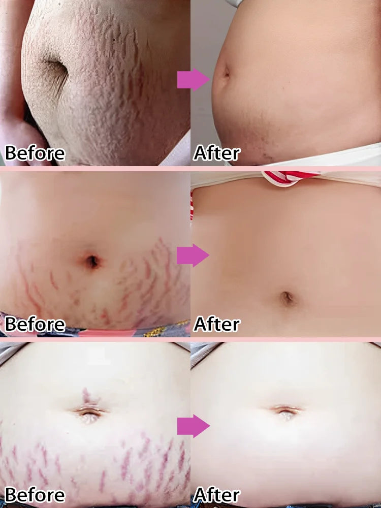 Body essential oil suitable for pregnant women, remove stretch marks, moisturize and soothe skin
