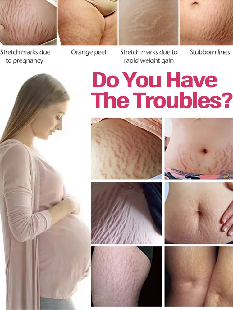 Body essential oil suitable for pregnant women, remove stretch marks, moisturize and soothe skin