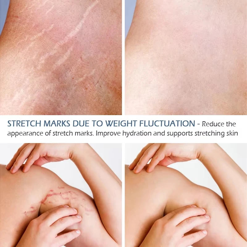 Stretch Marks Oil Maternity Pregnant Women Pregnancy Anti-Winkle Smooth Repair