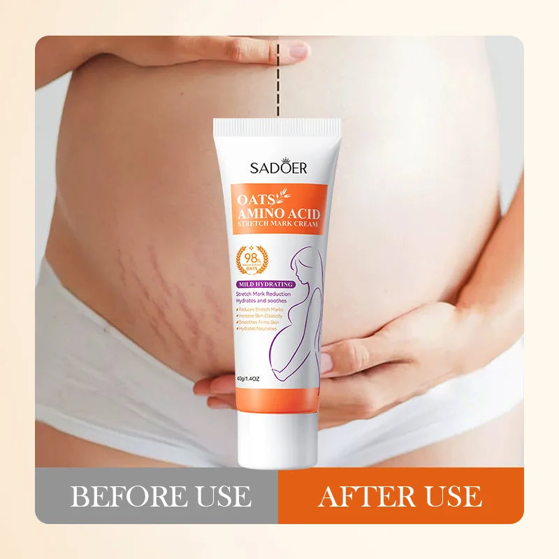 Stretch Marks Oil Maternity Pregnant Women Pregnancy Anti-Winkle Smooth Repair