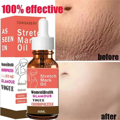 Stretch Marks Oil Maternity Pregnant Women Pregnancy Anti-Winkle Smooth Repair