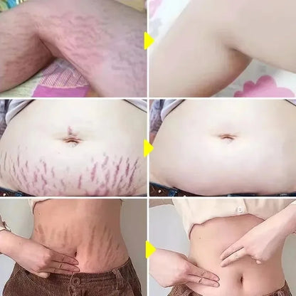 Stretch Marks Oil Maternity Pregnant Women Pregnancy Anti-Winkle Smooth Repair